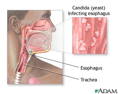 candidal-esophagitis.jpg