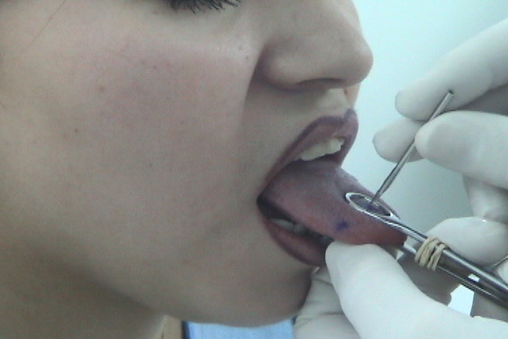 Piercing the tongue Care There are definitely some ways to protect yourself