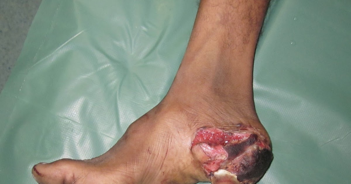 Calcaneus Fracture Recovery - Fracture Treatment