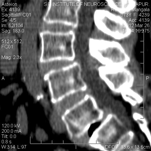 Dr Balaji Anvekar FRCR Intradiscal Vacuum Phenomenon