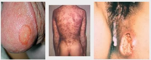 Image Obat terbaik untuk sipilis