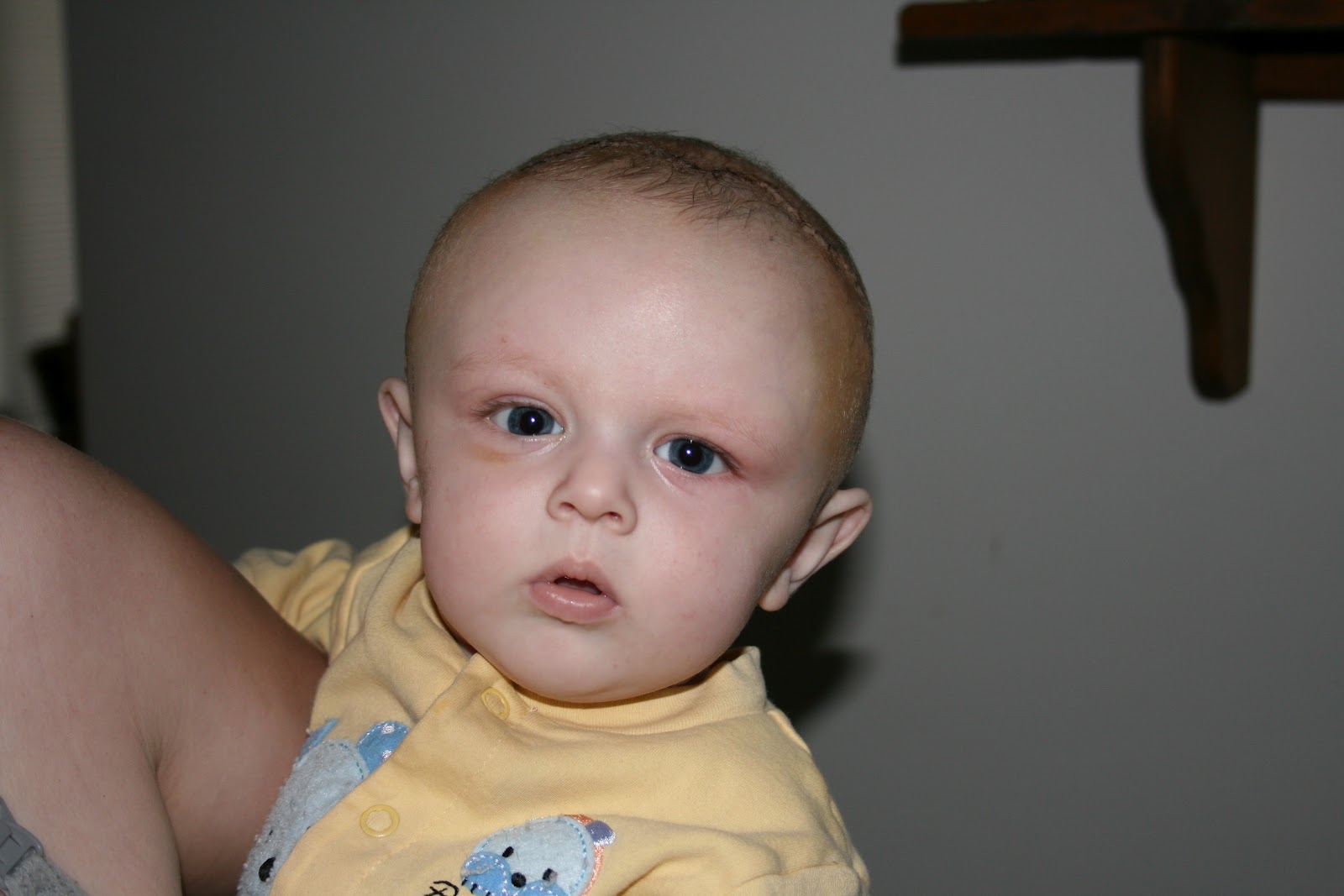 FATTKAW: Metopic Ridge and it is gone...