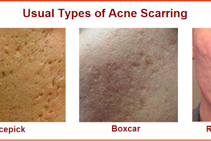 Medical Pictures Info \u2013 Cystic Acne