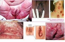 sipilis obat sipilis alami