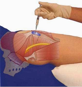 Greater trochanteric steroid injection