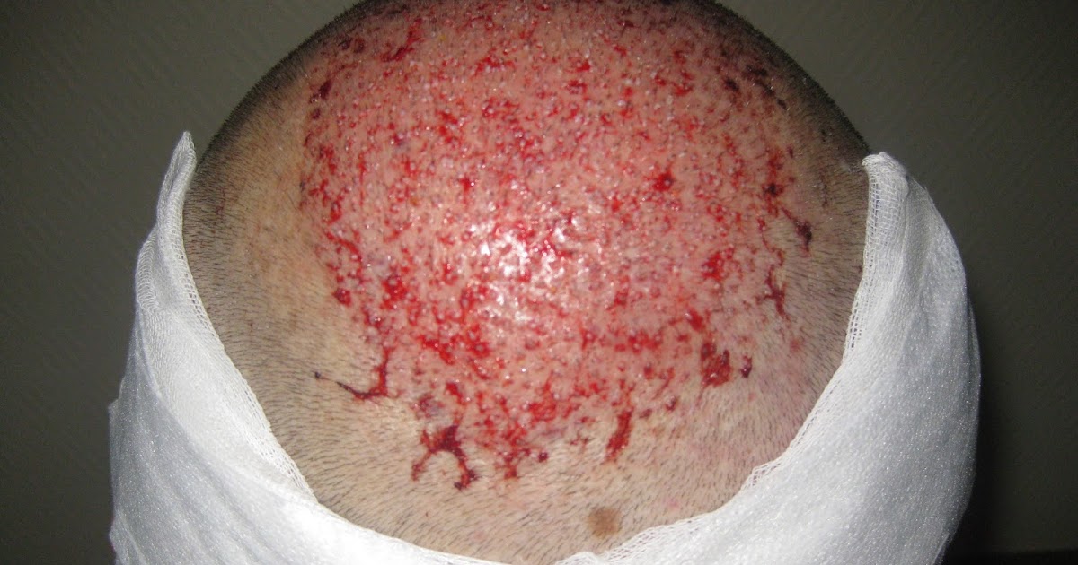 effet secondaire greffe de cheveux | médical santé effet secondaire greffe de cheveux | médical santé