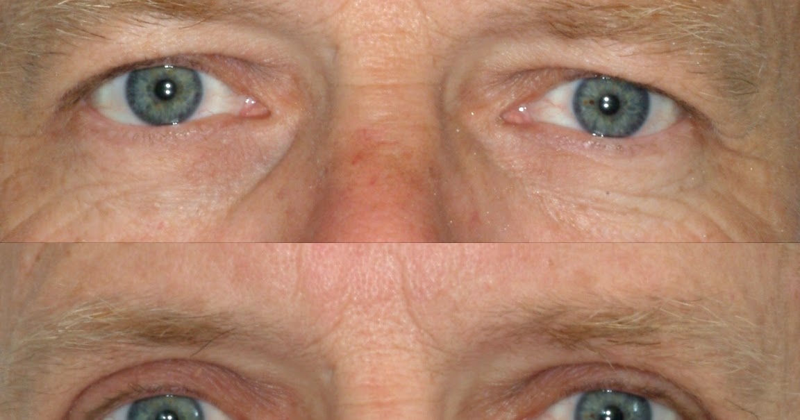 SKINALITY Laser Blepharoplasty vs. Scalpel Blepharoplasty