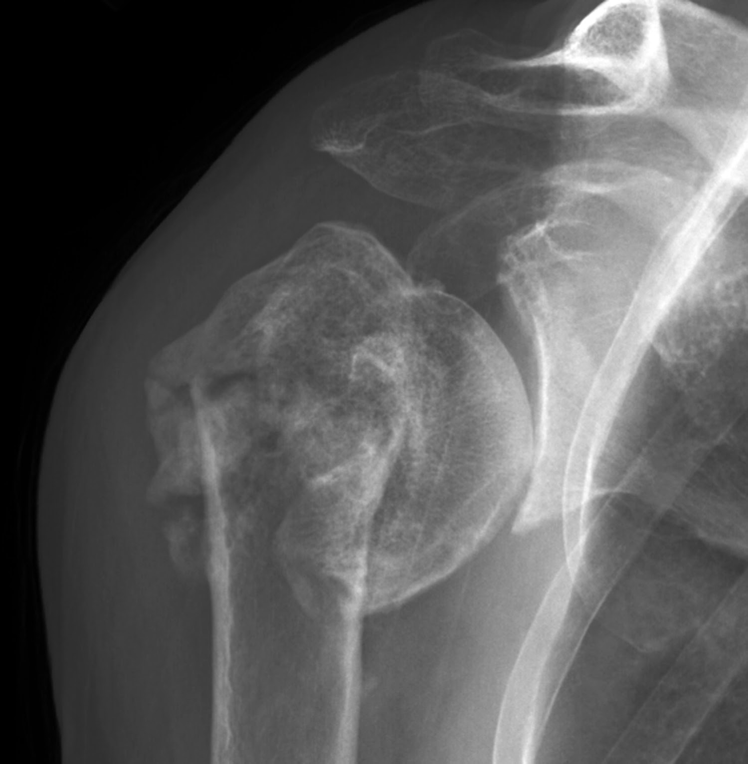 Shoulder Arthritis / Rotator Cuff Tears causes of shoulder pain