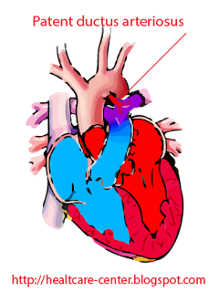 Patent ductus arteriosus