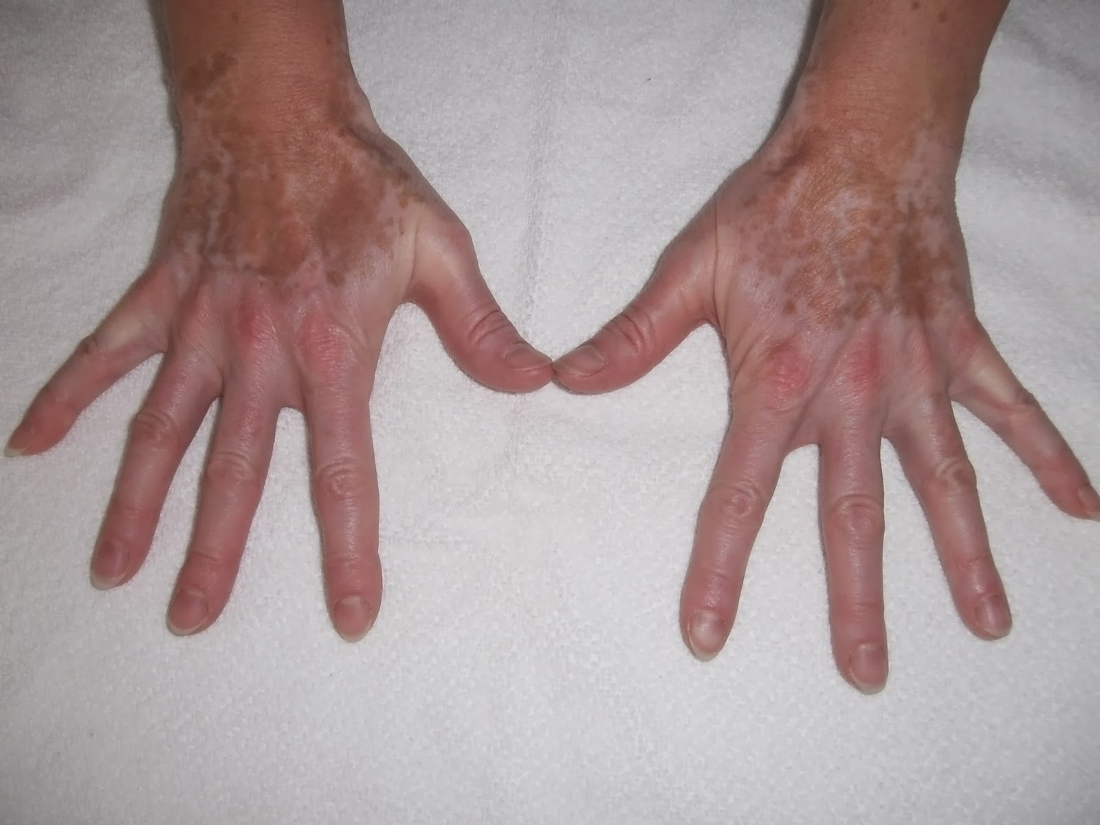 Rheumatologe Vitiligo in a Patient with Rheumatoid Arthritis under
