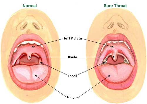 Tonsils Bad Breath Children : Tonsil Stones - How I Cured My Own Tonsil Stones And Bad Breath