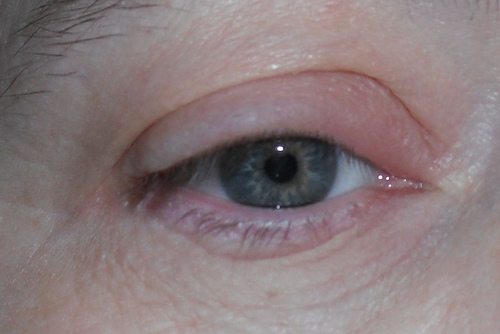 Las ojeras negras la causa a los hombres el tratamiento