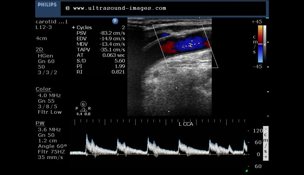 carotid doppler ultrasound cpt code