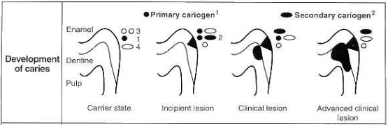 Classification of Dental Caries image14 Classification of Dental Caries