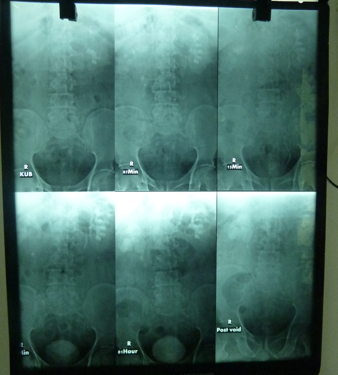 Ramayya Pramila Urology Hospital Partial staghorn kidney stone removed