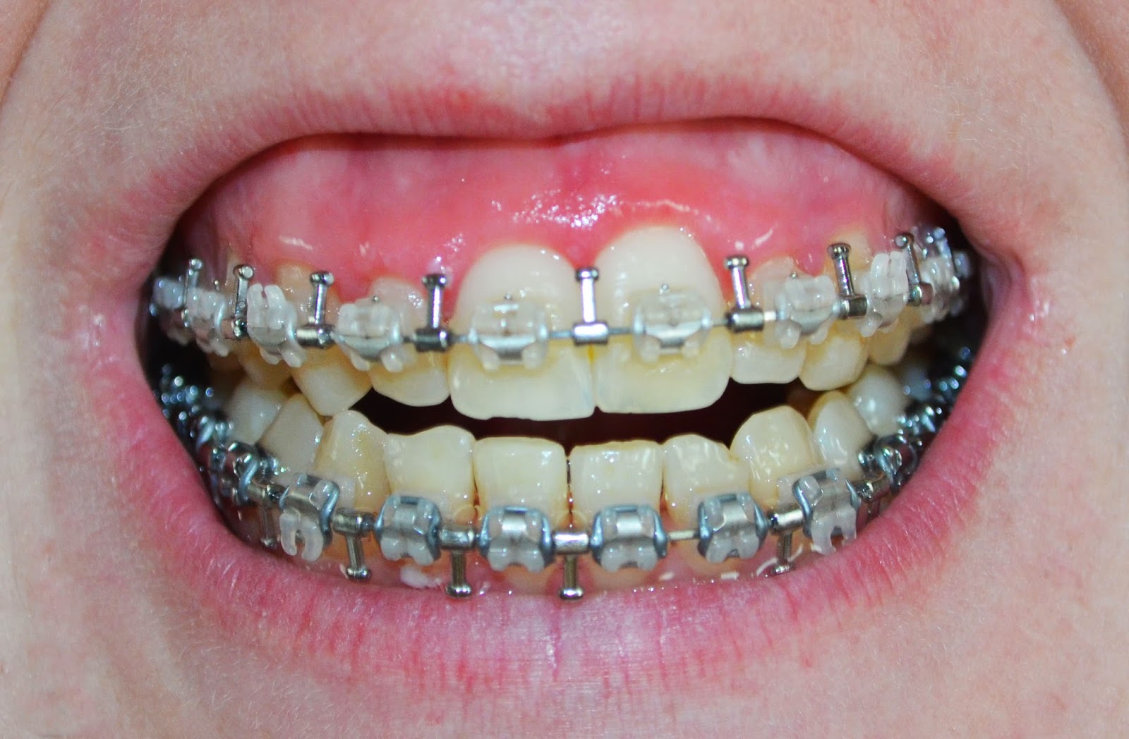 Amy's SARPE Adventure July 2014 Top and Bottom Surgery Round Two