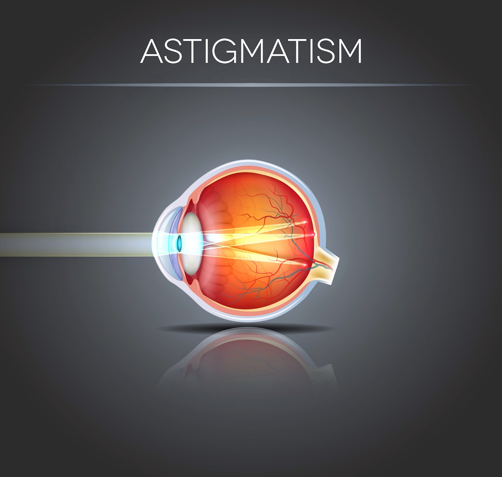 Astigmatism, Vision and Hormone Imbalance Fix My PCOS