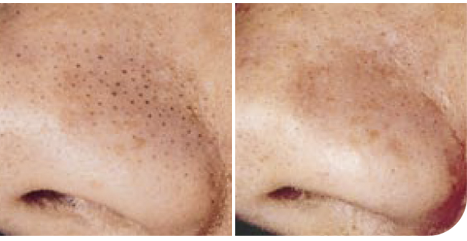 How To Get Rid Of Blackheads On Nose Naturally How To Get Rid Of