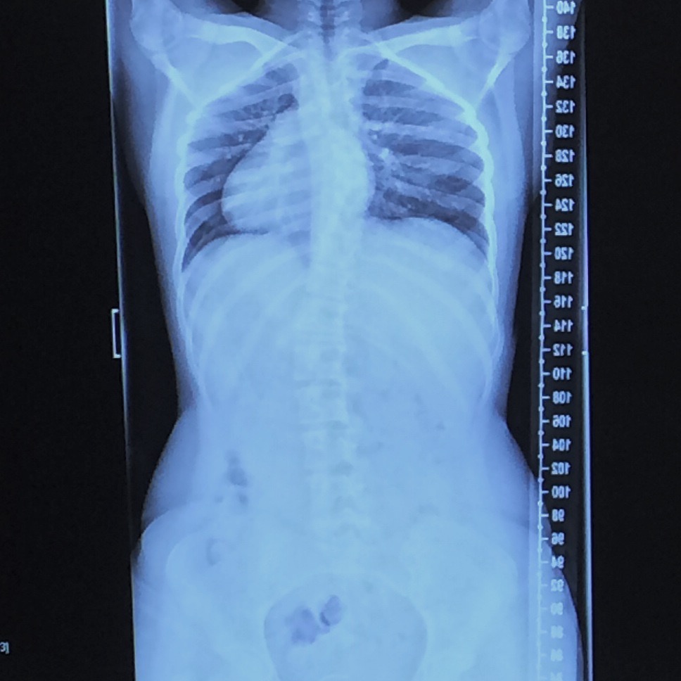 Scoliosis Post Op 2 Years! + FAQ's Titanium Chic