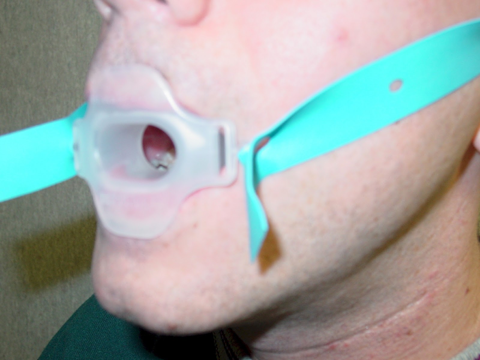 The top picture is the bite block for an endoscope and the bottom