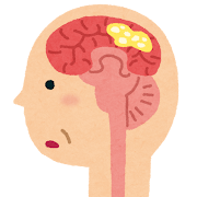 認知症の脳のイラスト（レビー小体型）