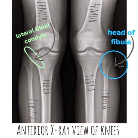 The Hip Joint: 1 of 3 Hamstrings: Biceps Femoris
