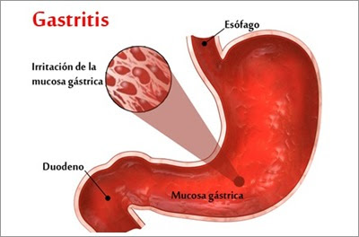 Pengobatan Tradisional Gastritis Yang Ampuh | Pengobatan Tradisional Paru Paru Basah