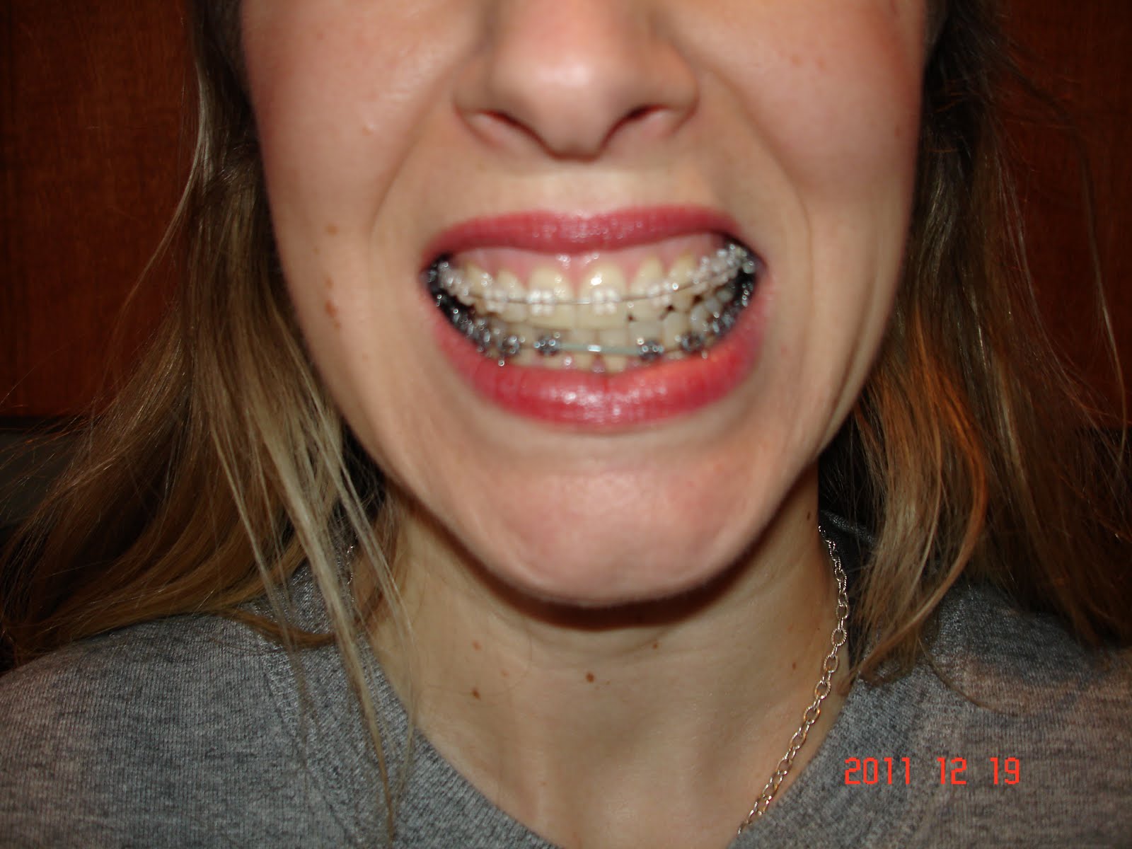 Amy's Adventure With Braces Before and After Pics