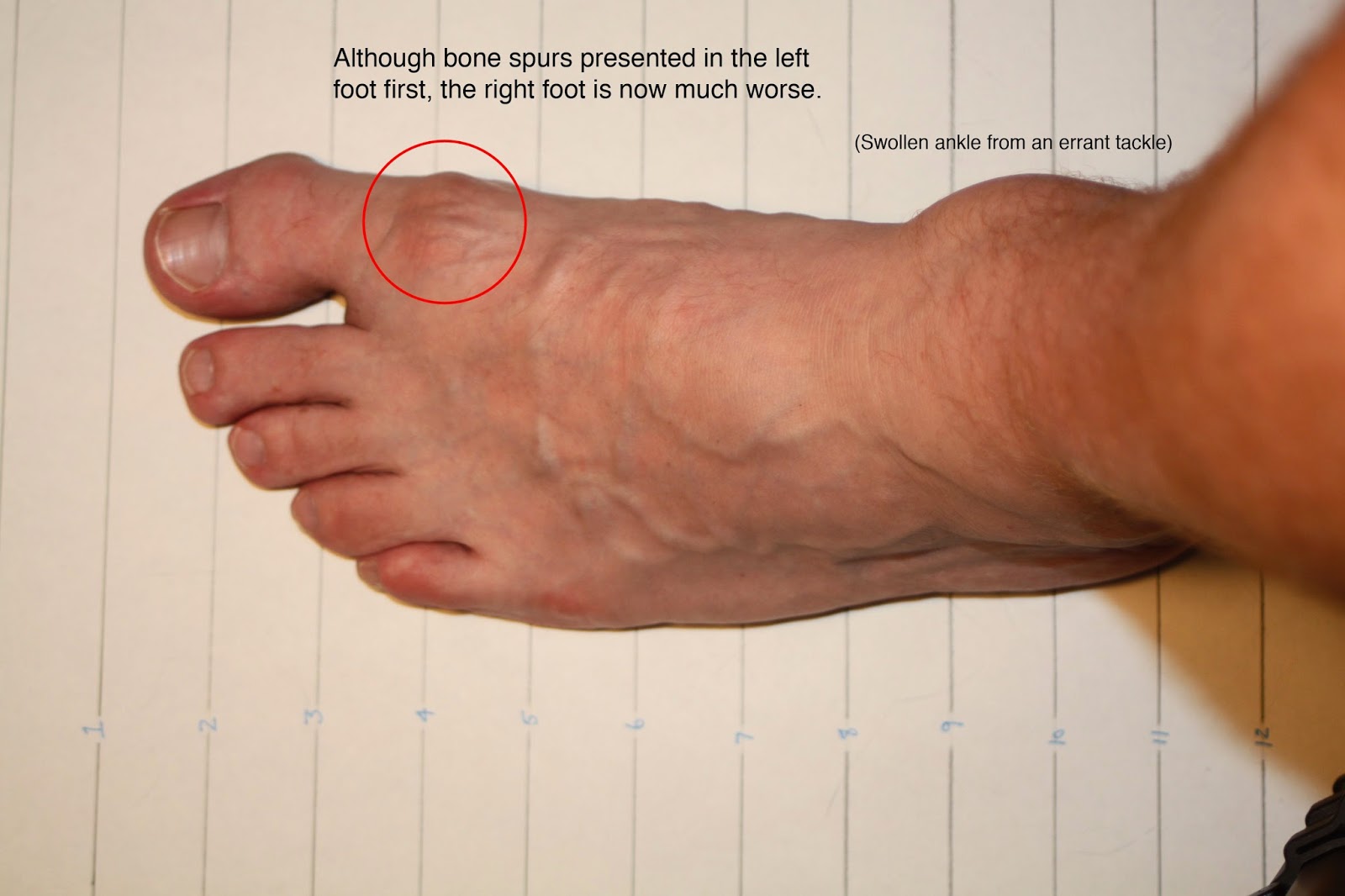 extreme anal penetration videos bone spurs on bottom of foot