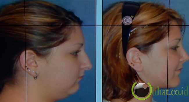 Operasi Dagu (chinplant) Operasi Dagu (chinplant)