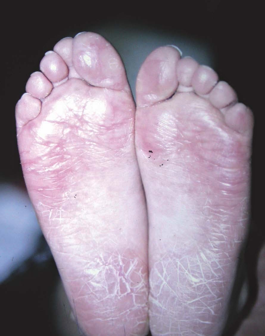 Farmacia Antonio Busto Cuíñas Pie de atleta o tiña del pie, qué es