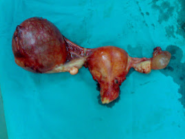 Left para ovarian cyst -TAH and BSO done by Dr. Alaa Mosbah