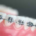 Bahaya Menggunakan Kawat Gigi atau Behel