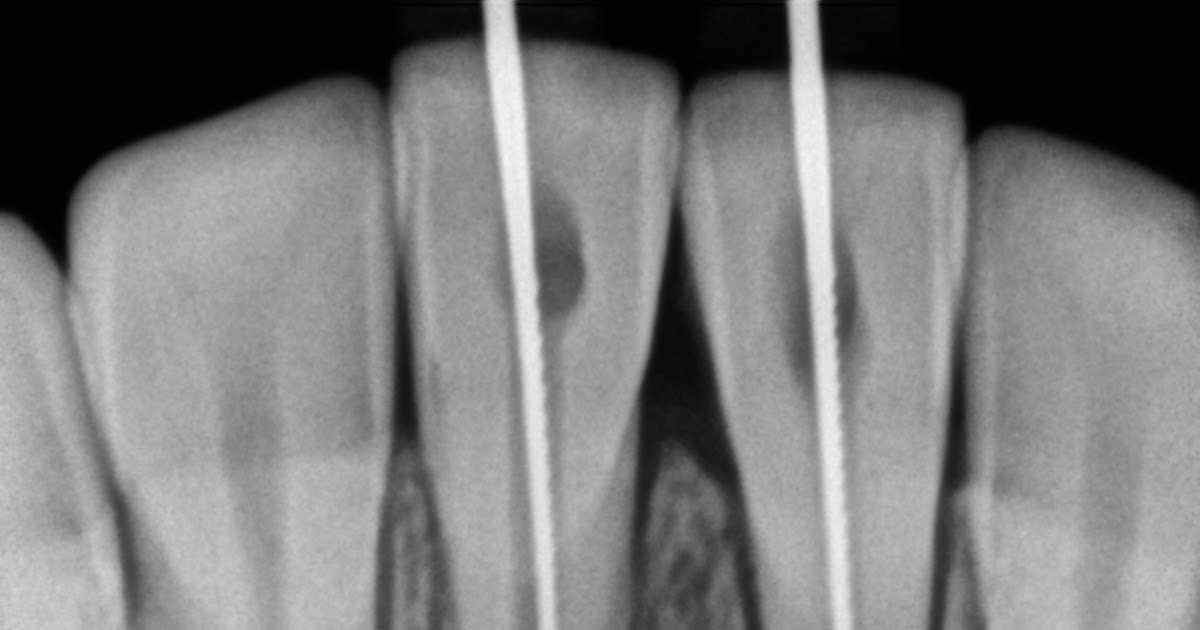 Endodontics Length of master cone determiantion