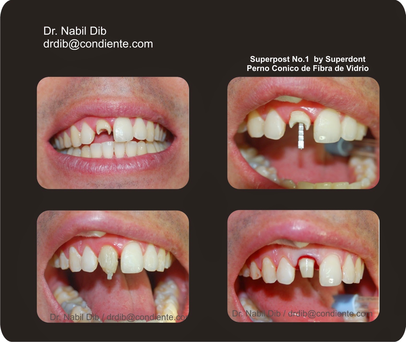 Dr. Nabil Dib Restauración de Fractura Anterior UD11 / Tooth Fracture