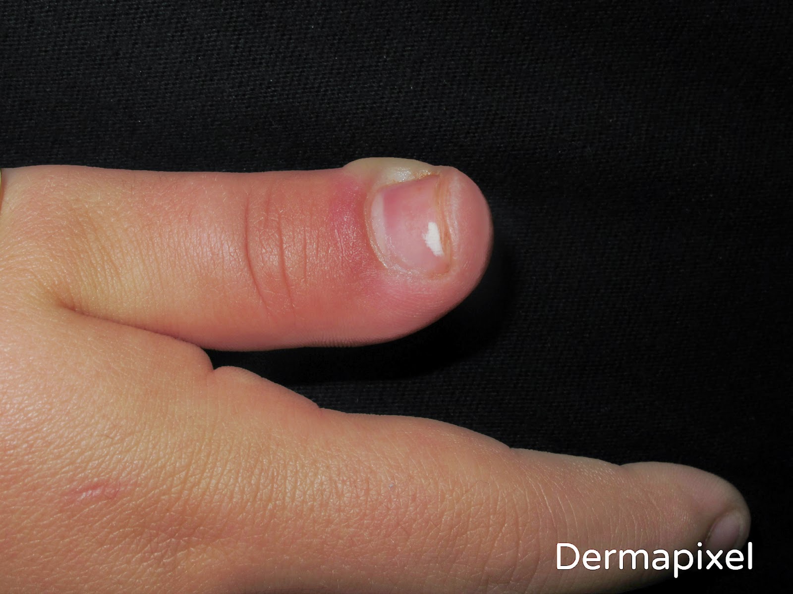 Dermapixel: Me duele el dedo