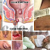 Obat Alami Pasca Operasi Hemoroid (Wasir) thumbnail