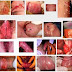 Cara Menuntaskan SIPILIS dengan Obat AntiBiotik Alami thumbnail