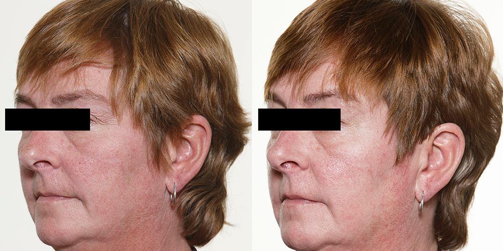 pmd microderm before and after pmd microderm before and after