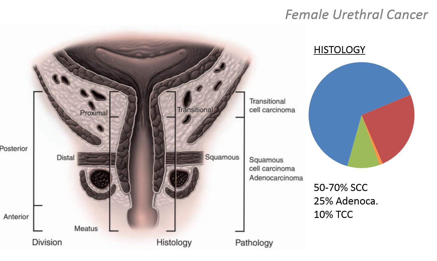Brady Urology at Johns Hopkins Hospital Urethral Cancer Basics of