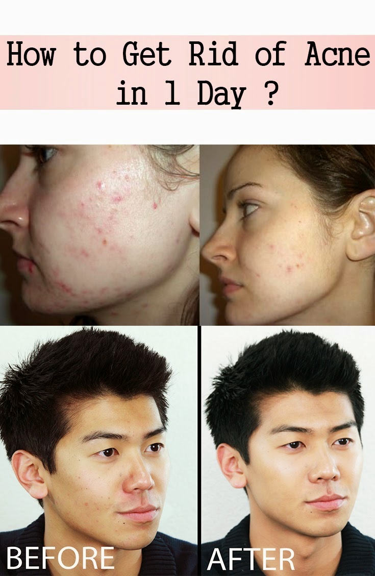 How to Get Rid of Acne in 1 Day? Natural Solutions