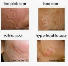 Aside How To Treat Acne In 7 Days Naturally