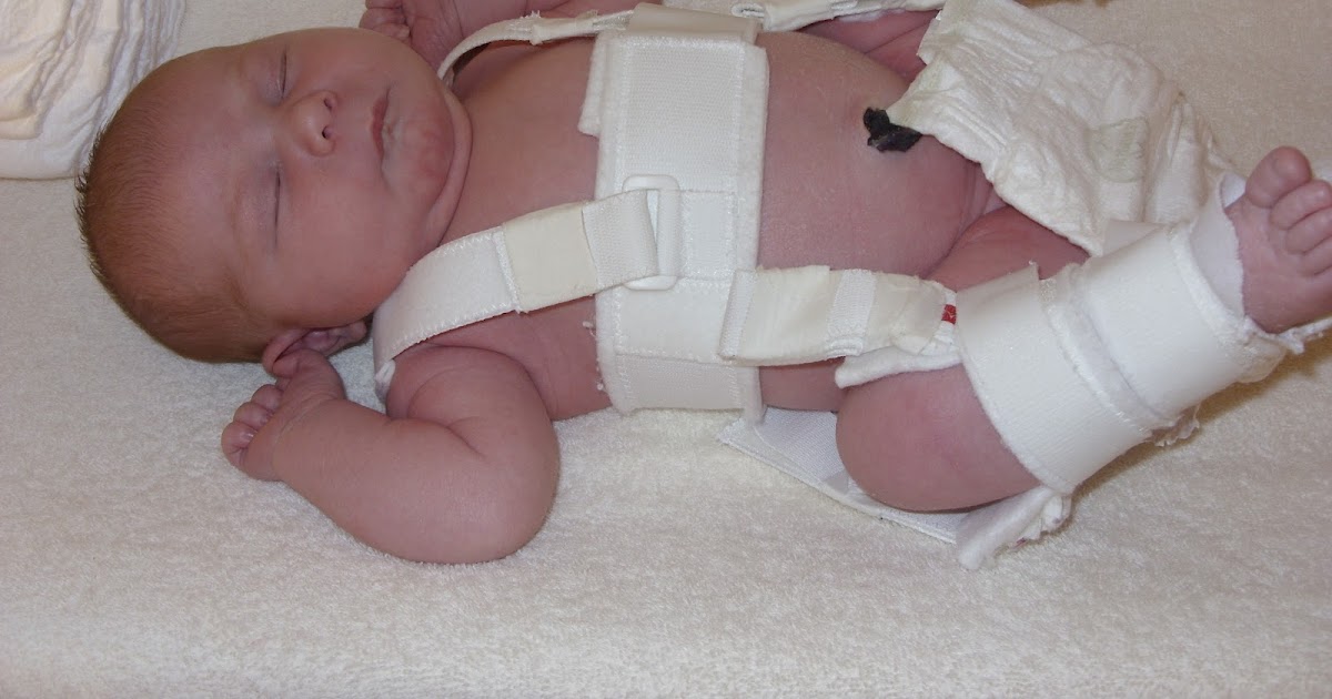 Hip Dysplasia In Babies Surgery Get More Anythink's
