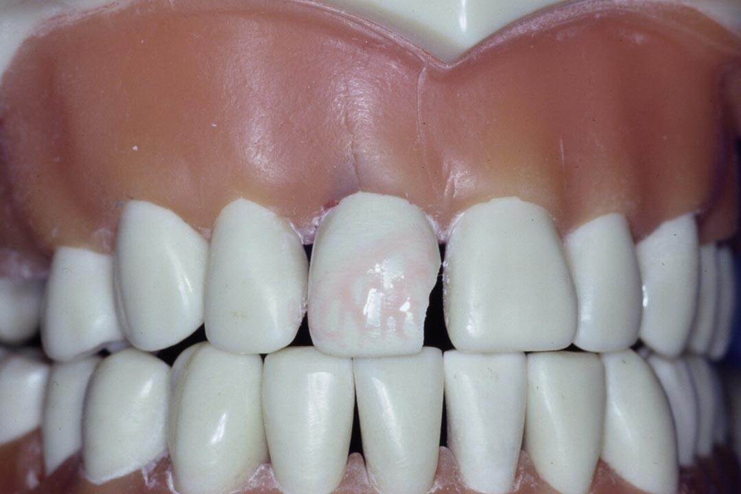 Dentistry Custom Cast Dowel Core