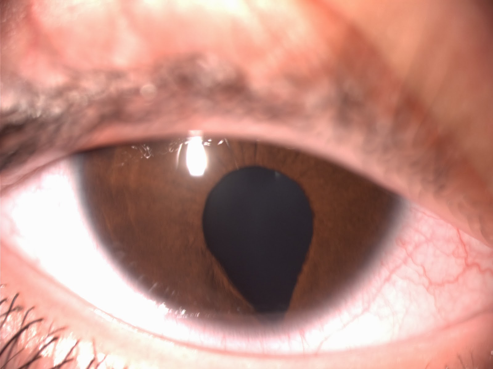 coloboma pupil coloboma pupil