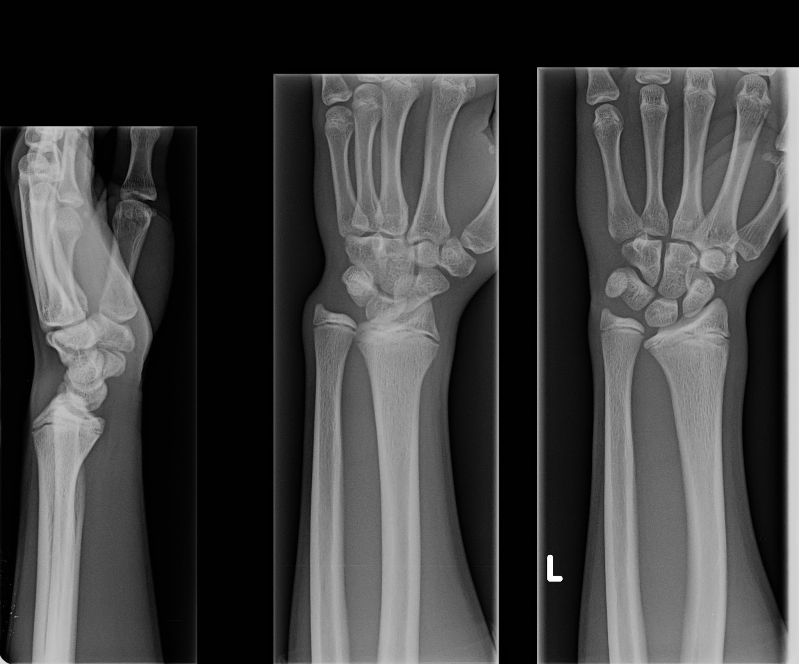 Traumatic Madelungs Deformity | Congenital Hand and Arm Differences