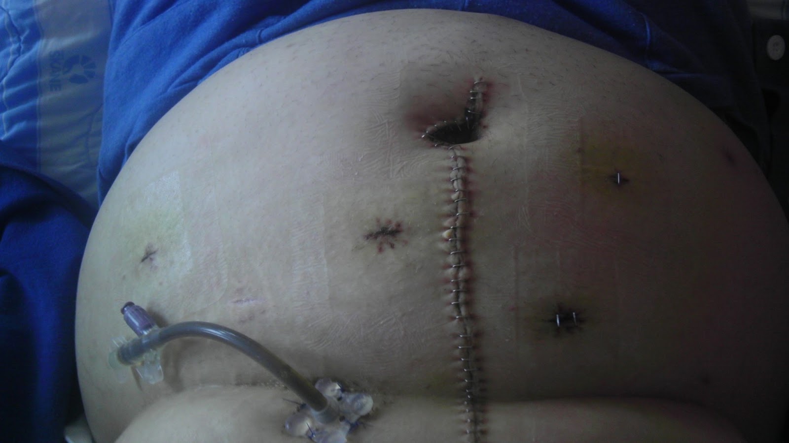 gastric bypass ont i magen gastric bypass ont i magen