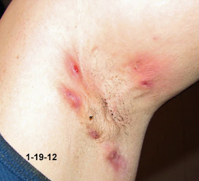 Learning how to Heal Hidradenitis Suppurativa