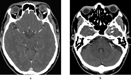 cavernous sinus thrombosis