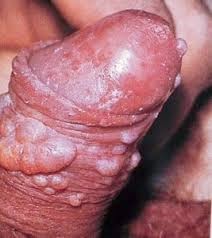Cara Membuat Obat Herbal Kencing Nanah Cara Membuat Obat Herbal Kencing Nanah